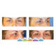 Blefaroplastika - pomladite se uz zahvat na oba oka i uključenu anesteziju i ...